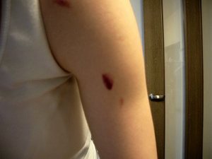 鬱血だらけ。 鬱血だらけ。